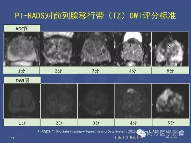 【PPT】前列腺影像报告和数据系统
