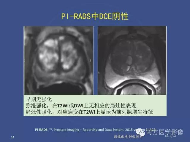 【PPT】前列腺影像报告和数据系统