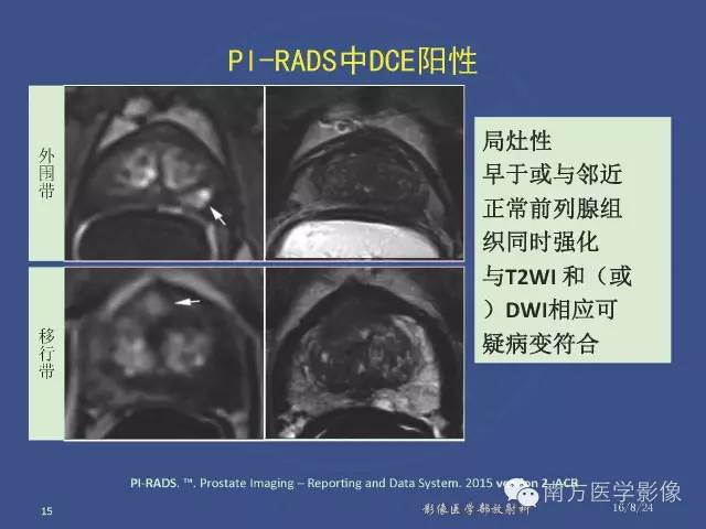 【PPT】前列腺影像报告和数据系统