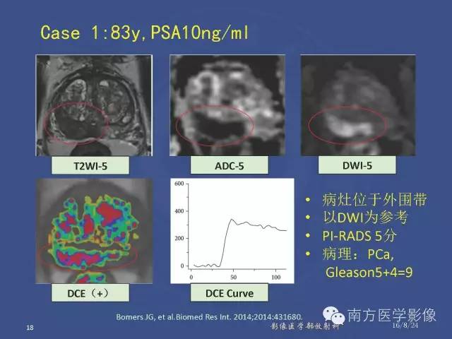 【PPT】前列腺影像报告和数据系统