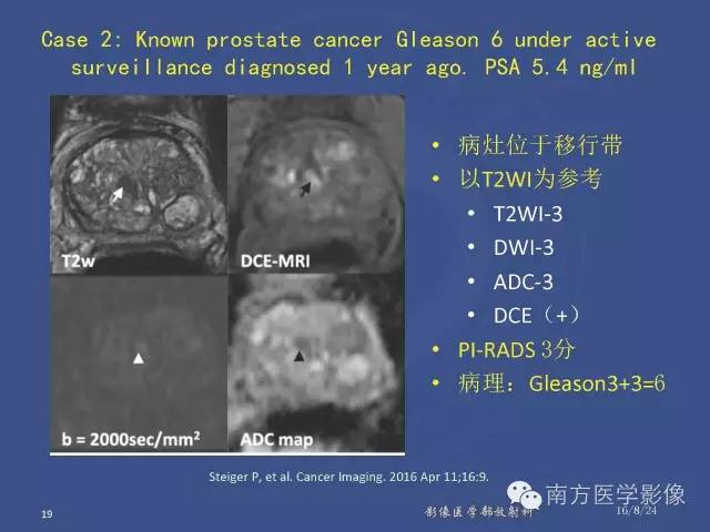 【PPT】前列腺影像报告和数据系统