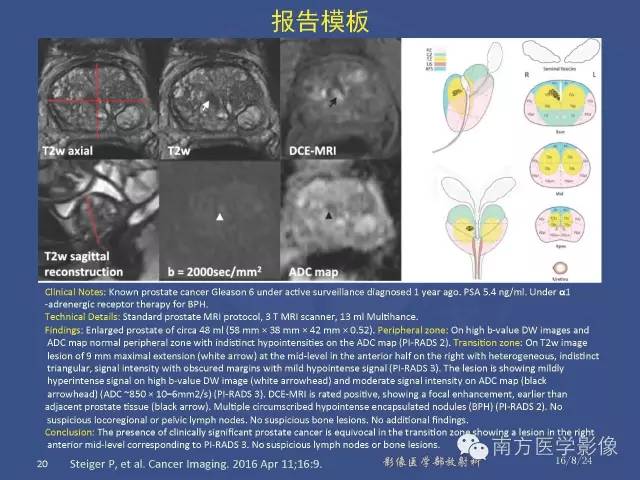 【PPT】前列腺影像报告和数据系统
