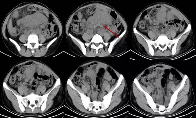 【病例】腹膜后淋巴瘤1例CT诊断要点 【病例】腹膜后淋巴瘤1例CT诊断要点