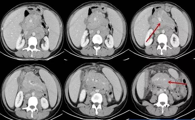 【病例】腹膜后淋巴瘤1例CT诊断要点 【病例】腹膜后淋巴瘤1例CT诊断要点