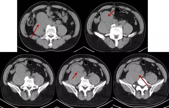 【病例】腹膜后淋巴瘤1例CT诊断要点 【病例】腹膜后淋巴瘤1例CT诊断要点