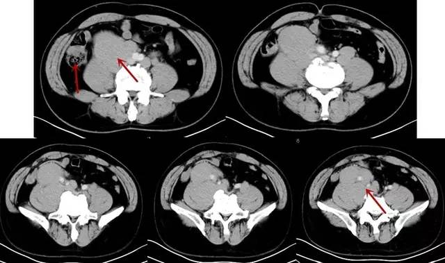 【病例】腹膜后淋巴瘤1例CT诊断要点 【病例】腹膜后淋巴瘤1例CT诊断要点