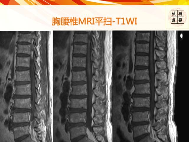 【病例】硬脊膜动静脉瘘1例MR影像表现