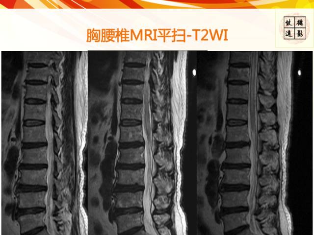 【病例】硬脊膜动静脉瘘1例MR影像表现
