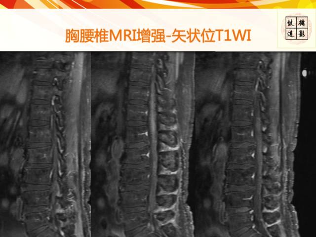 【病例】硬脊膜动静脉瘘1例MR影像表现