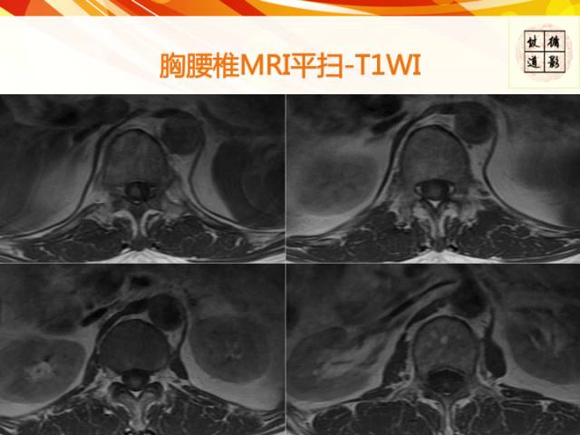 【病例】硬脊膜动静脉瘘1例MR影像表现