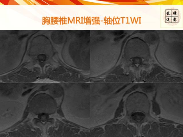 【病例】硬脊膜动静脉瘘1例MR影像表现