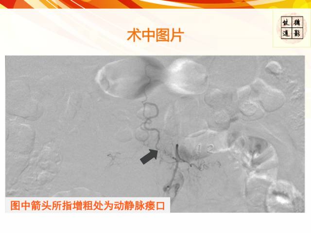【病例】硬脊膜动静脉瘘1例MR影像表现