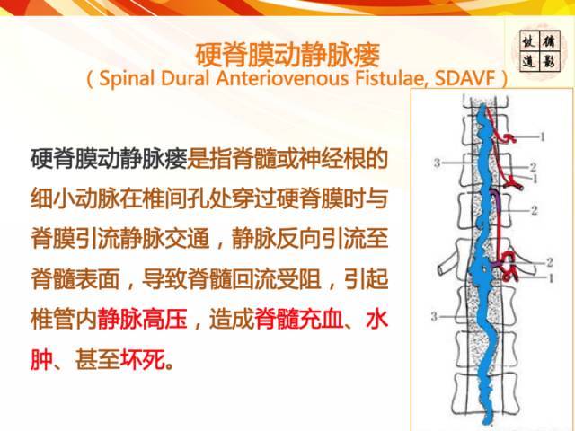 【病例】硬脊膜动静脉瘘1例MR影像表现