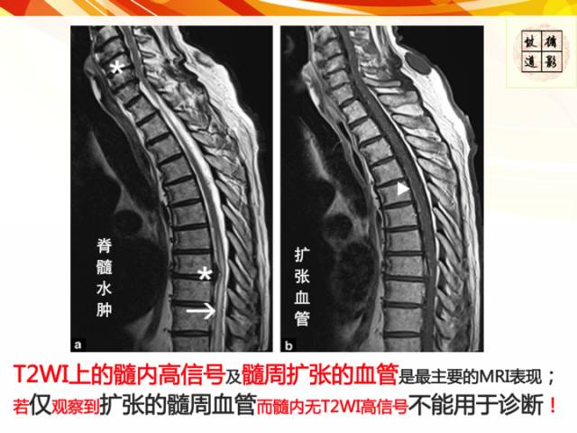 【病例】硬脊膜动静脉瘘1例MR影像表现
