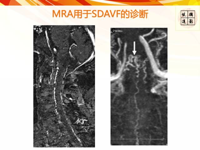 【病例】硬脊膜动静脉瘘1例MR影像表现