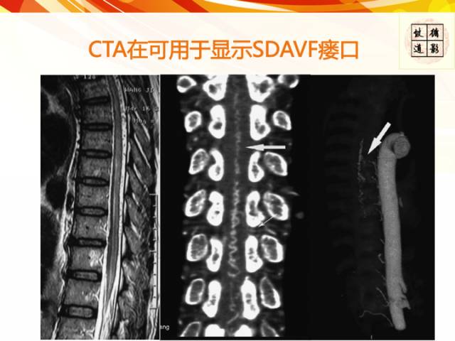 【病例】硬脊膜动静脉瘘1例MR影像表现