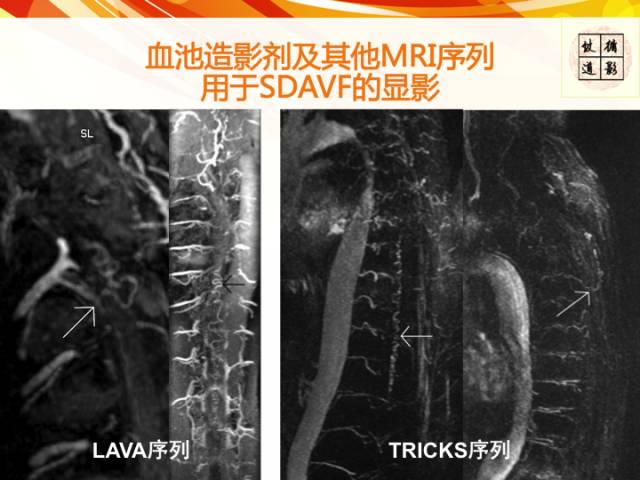 【病例】硬脊膜动静脉瘘1例MR影像表现
