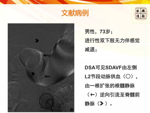 【病例】硬脊膜动静脉瘘1例MR影像表现