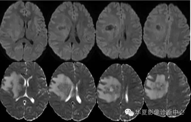 【病例】颅内真菌性肉芽肿1例MR影像表现 【病例】颅内真菌性肉芽肿1例MR影像表现