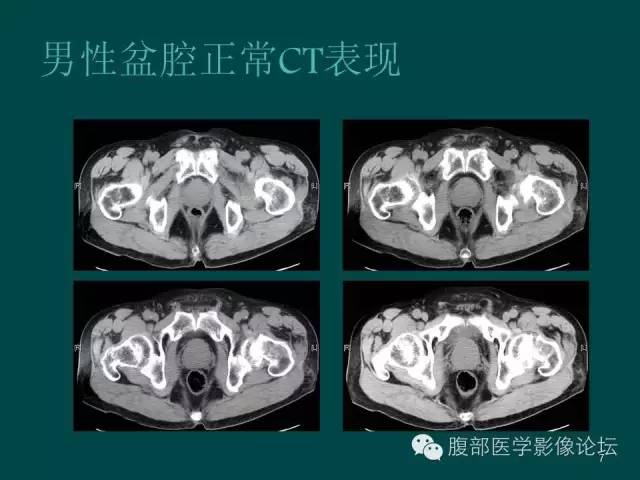 【PPT】盆腔病变的CT诊断