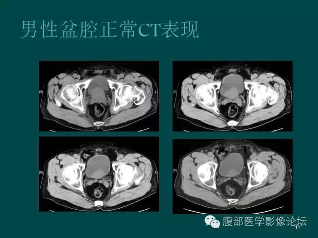 【PPT】盆腔病变的CT诊断