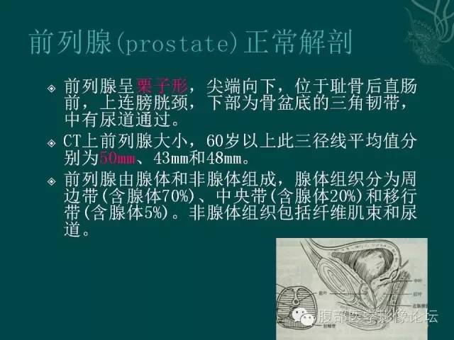 【PPT】盆腔病变的CT诊断