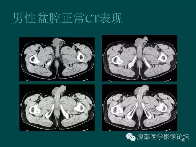【PPT】盆腔病变的CT诊断