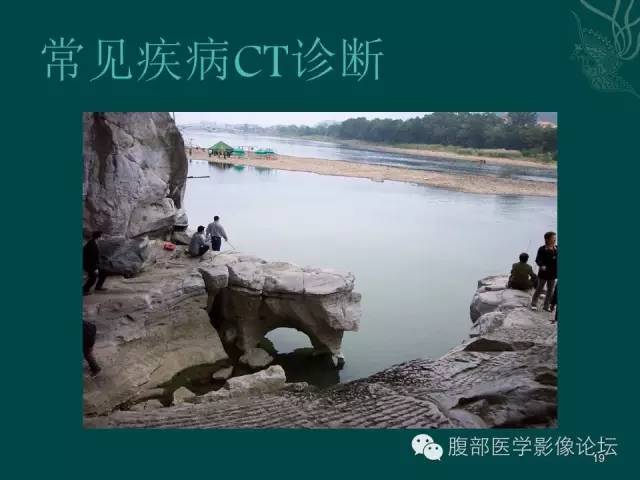 【PPT】盆腔病变的CT诊断