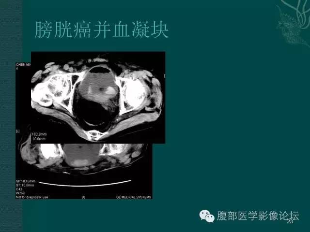 【PPT】盆腔病变的CT诊断