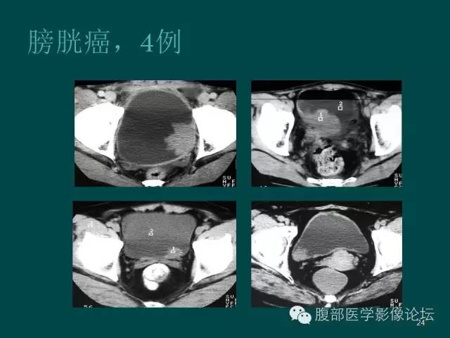 【PPT】盆腔病变的CT诊断