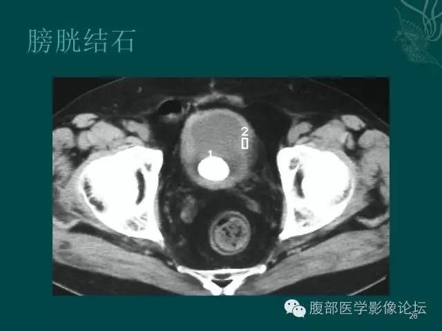 【PPT】盆腔病变的CT诊断