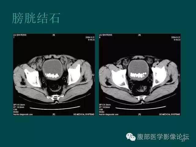 【PPT】盆腔病变的CT诊断