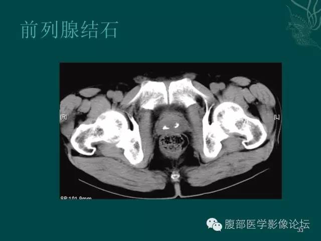 【PPT】盆腔病变的CT诊断