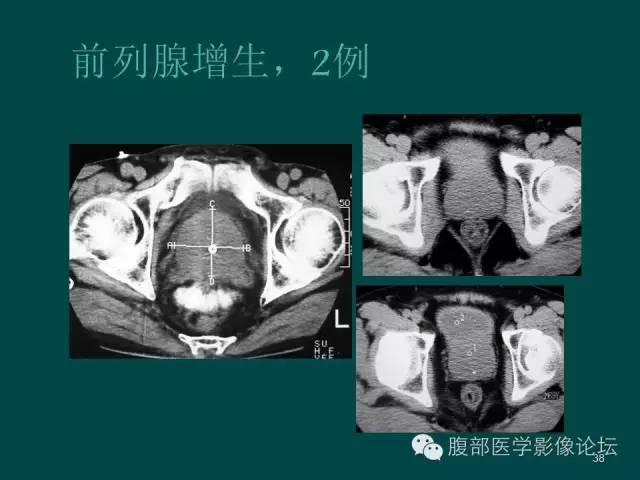 【PPT】盆腔病变的CT诊断