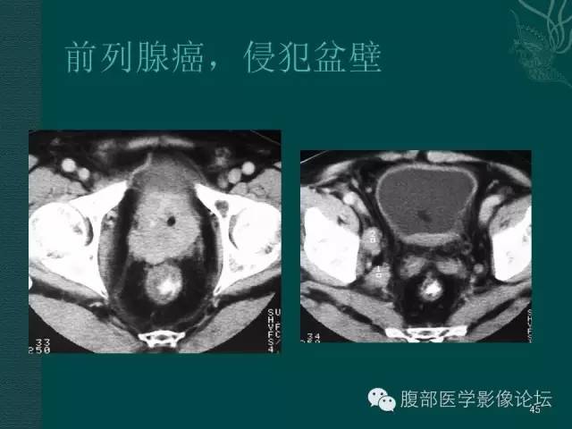 【PPT】盆腔病变的CT诊断
