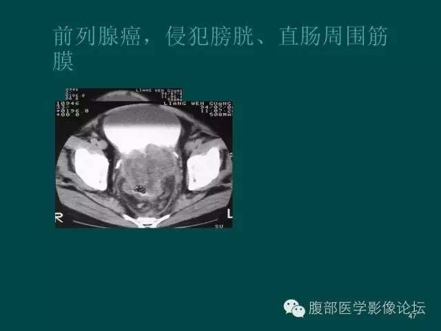【PPT】盆腔病变的CT诊断
