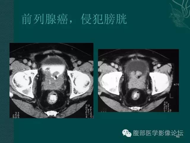 【PPT】盆腔病变的CT诊断