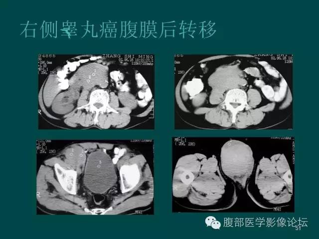 【PPT】盆腔病变的CT诊断