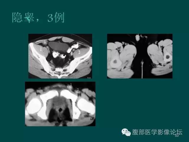 【PPT】盆腔病变的CT诊断