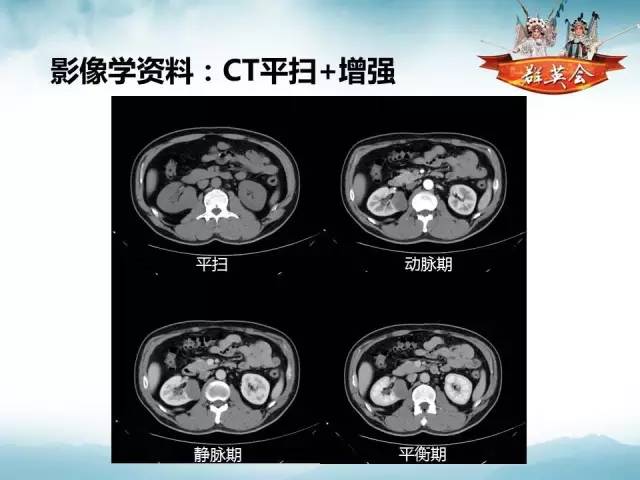 【病例】肾乳头状细胞癌1例CT影像表现