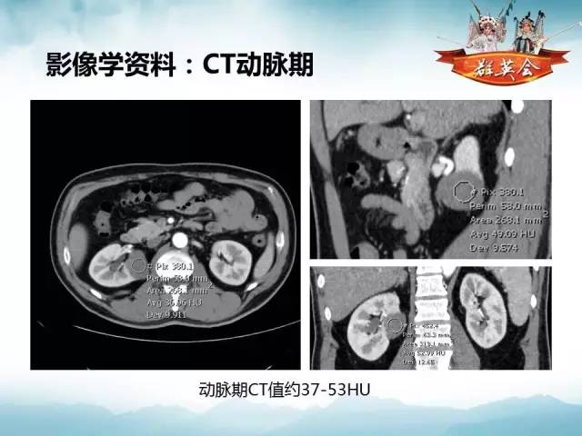 【病例】肾乳头状细胞癌1例CT影像表现