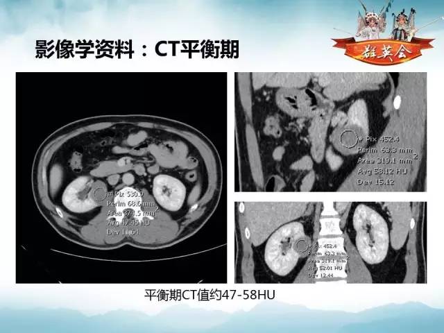 【病例】肾乳头状细胞癌1例CT影像表现
