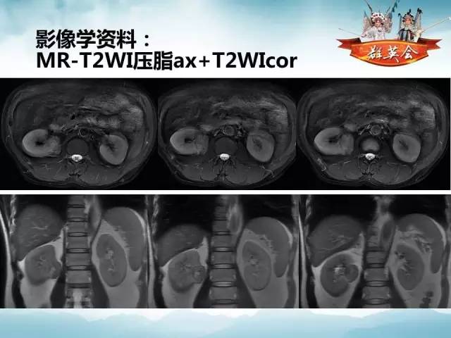 【病例】肾乳头状细胞癌1例CT影像表现
