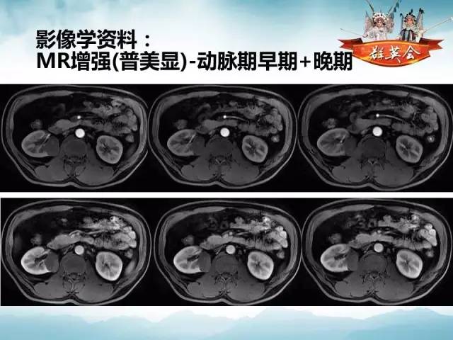 【病例】肾乳头状细胞癌1例CT影像表现