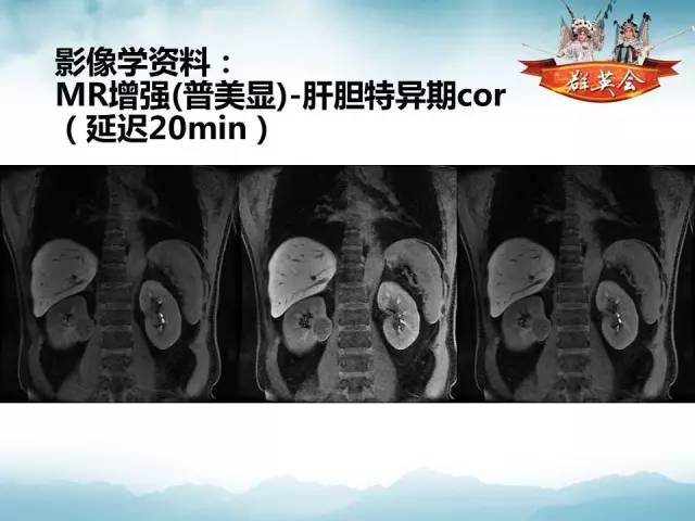 【病例】肾乳头状细胞癌1例CT影像表现