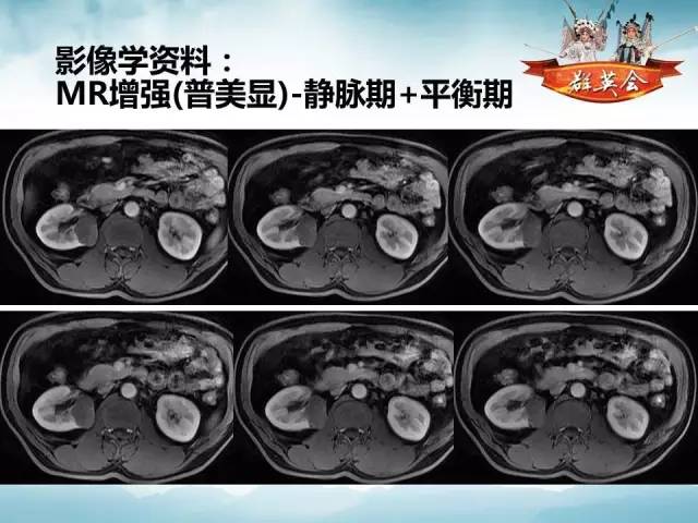 【病例】肾乳头状细胞癌1例CT影像表现