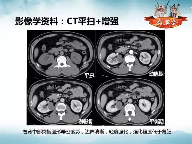 【病例】肾乳头状细胞癌1例CT影像表现