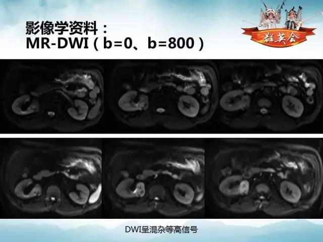 【病例】肾乳头状细胞癌1例CT影像表现
