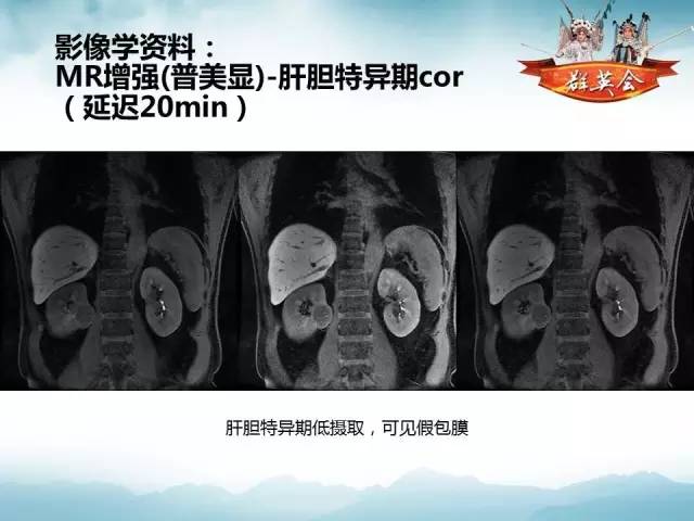 【病例】肾乳头状细胞癌1例CT影像表现