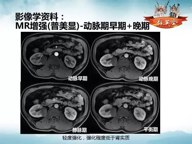 【病例】肾乳头状细胞癌1例CT影像表现